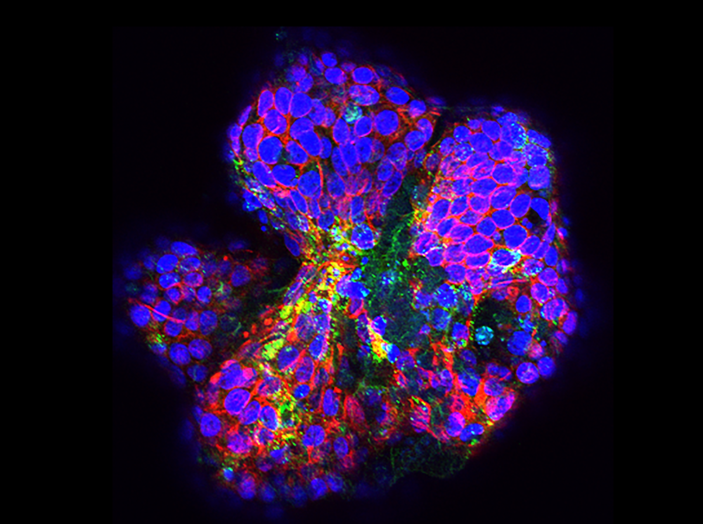 Primary human intestinal organoid infected with coxsackievirus B. Actin staining in red and viral RNA is green (DAPI-stained nuclei in blue).
